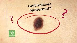 Harmloses Muttermal Oder Hautkrebs Youtube