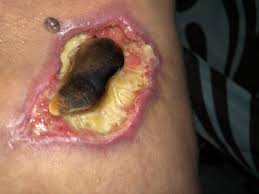 Causing tissue necrosis and formation of a black eschar.6 exaggerated curative properties of bloodroot are. Eschar Tissue Picture