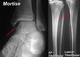 We look at the most common shoulder pain causes, how they present, how to treat them and how to prevent shoulder pain from taking over your life. High Ankle Sprain Syndesmosis Injury Foot Ankle Orthobullets