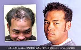 Jon Gosselin Before And After Hair Transplant Hairtx Drsamlam Hairdisorders Hairtransplant Celebrit Hair Transplant Hair Loss Hair Transplant Procedure