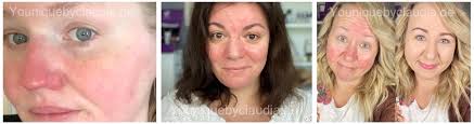 Learn the symptoms, causes, and treatment of rosacea, a skin condition that causes redness and bumps on your face. Welche Pflege Bei Couperose Rosazea Neurodermitis Co