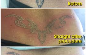 1410 tattoo is a professional tattoo shop home of tattoo artists with experience of more than 10 years located in maynooth. Laser Tattoo Removal The House Of Nails