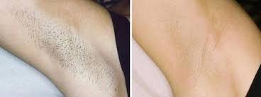 For a package with 5 to 6 sessions, laser hair removal for small area costs $220 to $800. Auckland Laser Hair Removal