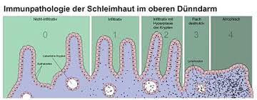 Es stuft das eigentlich harmlose klebereiweiß gluten als gefährlich ein. Zoliakie Wikipedia