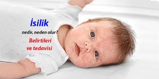 isilik nedir neden olur isilige ne iyi gelir belirtileri ve tedavisi