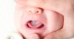 Mundsoor Beim Baby Ursachen Symptome Behandlung