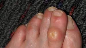 Wir hätten es auch nicht gedacht, aber dieses billige hausmittel bekämpft rissige hornhaut wie kein anderes aus dem drogeriemarkt! Hornhaut Und Huhneraugen Deximed