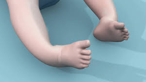 In clubfoot, the tissues connecting the muscles to the bone (tendons) are shorter than usual. Clubfoot Treatment Bilateral Club Feet Foot Pain