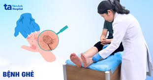 Bệnh ghẻ là gì? Nguyên nhân do đâu? 3 dấu hiệu nhận biết cụ thể