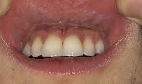 Clusters Of White Bumps On Gums Dentistry