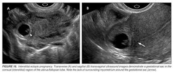 Image result for corpus luteum sonography)