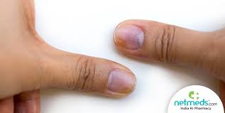 Toenail discoloration can be a local problem—just something wrong with the toenail for a short period of time. Subungual Melanoma Causes Symptoms And Treatment