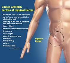 An Inguinal Hernia Is A Condition Which Occurs Due To Protrusion Of Soft Tissue Specifically Intestinal Part Hernia Symptoms Abdominal Hernia Hernia Inguinal
