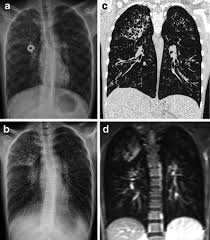 Read about the symptoms, causes and treatments. A 15 Year Old Girl With Cystic Fibrosis Examined With T Open I