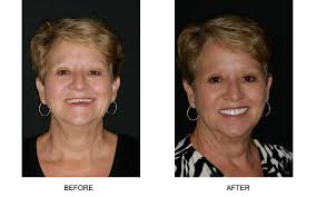 Greater chewing ability than missing teeth. Fountain Of Youth Dentures Complete Dentures