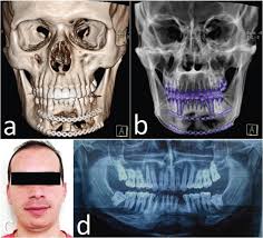 Aneurysmal bone cyst was first described as a distinct clinical and pathologic entity by jaffe and lichtenstein in 1942. Aneurysmal Bone Cyst Of The Mandible With Conservative Surgical Management A Case Report Abstract Europe Pmc