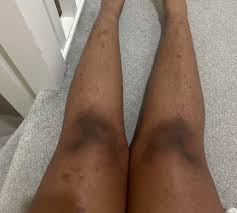 Image result for Pigment stains on the shin