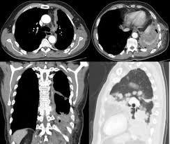 mesothelioma is an aggressive disease that requires an equally aggressive treatment strategy. A Thoracic Computed Tomography Of A Patient Diagnosed With Malignant Download Scientific Diagram