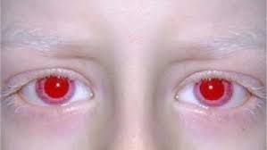 Top 10 Shocking Eye Disorders Albinism Albino Red Eyes Albino