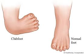 Image result for Clubfoot