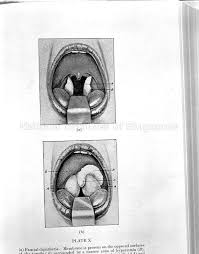 Although it spreads easily from one person to another, diphtheria can be prevented through the use. A Diagram Of The Mouth Shown During The Anti Diphtheria
