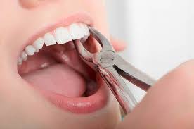 Image result for Tooth Extraction