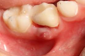 Baby Tooth Root Canal