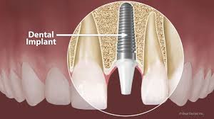 Image result for dental implant