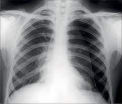 Pneumothorax is air around or outside the lung. Primary Spontaneous Pneumothorax To Pleurodese Or Not The Lancet