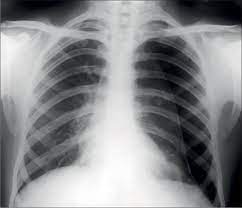 Pneumothorax, sometimes abbreviated to ptx, (plural: References In Primary Spontaneous Pneumothorax To Pleurodese Or Not The Lancet