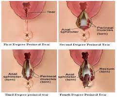 Check spelling or type a new query. Episiotomy Stitches Images Novocom Top