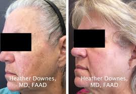 IPL Photofacial: Lake Forest Dermatology, Bannockburn (Chicago) IL — Lake  Forest Dermatology