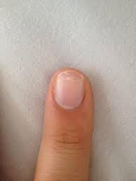 Bruchige Und Splitternde Nagel Hilfe Kaputt Nagellack Bruchig