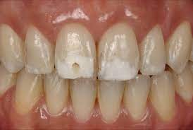 Treatment Of Extensive White Spots By Resin Infiltration Styleitaliano Org