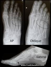 Image result for Metatarsal