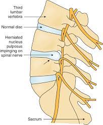 47 Lumbar Radiculopathy Clinical Gate