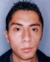 TESIS: REVISIÓN GENERAL DE ASPECTOS ORTODÓNCICOS, ORTOPÉDICOS Y QUIRÚRGICOS  DE LA MICROSOMÍA HEMIFACIAL