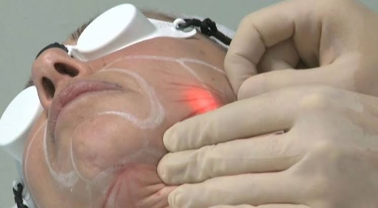 Endolift facelift in Bromley, Kent