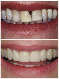 Gap teeth can create pockets between your teeth and gums where food can get stuck. Gap In Teeth Treatment Advanced Dentistry