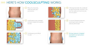 How long did it take for. Coolsculpting In Pasadena Non Surgical Fat Reduction