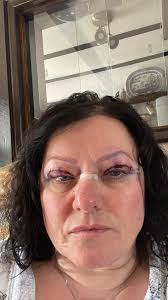 I had the surgery and never looked back. So happy. Would do it again in a  heart beat. Looks awful after surgery but not much pain.