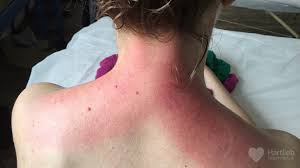 Gua sha jade stein gesichtsmassage chinesische medizin natural board scraping. Ausleiten Gua Sha Hartlieb Naturheilpraxis