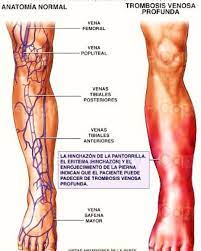 Causas de la trombosis venosa. Trombosis Venosa Inversiones Extrasistoles Health C A Facebook