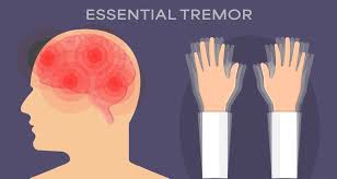 Image result for Rest Tremor
