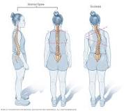 Image result for icd 10 code for mild lumbar scoliosis
