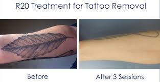 Older tattoos have had time to fade leaving less ink for tattoo removal. Laser Tattoo Removal Near Me Ny Nj Pa Book Today