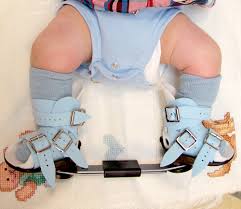 The shoe on the clubfoot is outwardly rotated 70 degrees and on the normal foot 45 degrees. Clubfoot International Center For Limb Lengthening