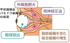 甲状腺眼症・バセドウ病眼症[橋本病 超音波エコー検査 甲状腺 専門医 長崎甲状腺クリニック大阪]