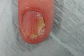 Image result for Onycholysis feet