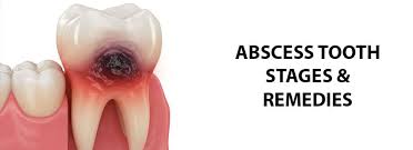 Image result for Periodontal Abscess